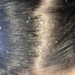 Seborrheic Dermatitis and Dandruff in Perth: Advanced Treatments for a Healthy, Flake-Free Scalp