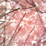 Scalp Psoriasis in Perth: Complete Guide for Long-Term Relief