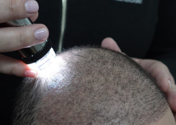 Scalp consultation with trichologist using trichoscopy in Perth